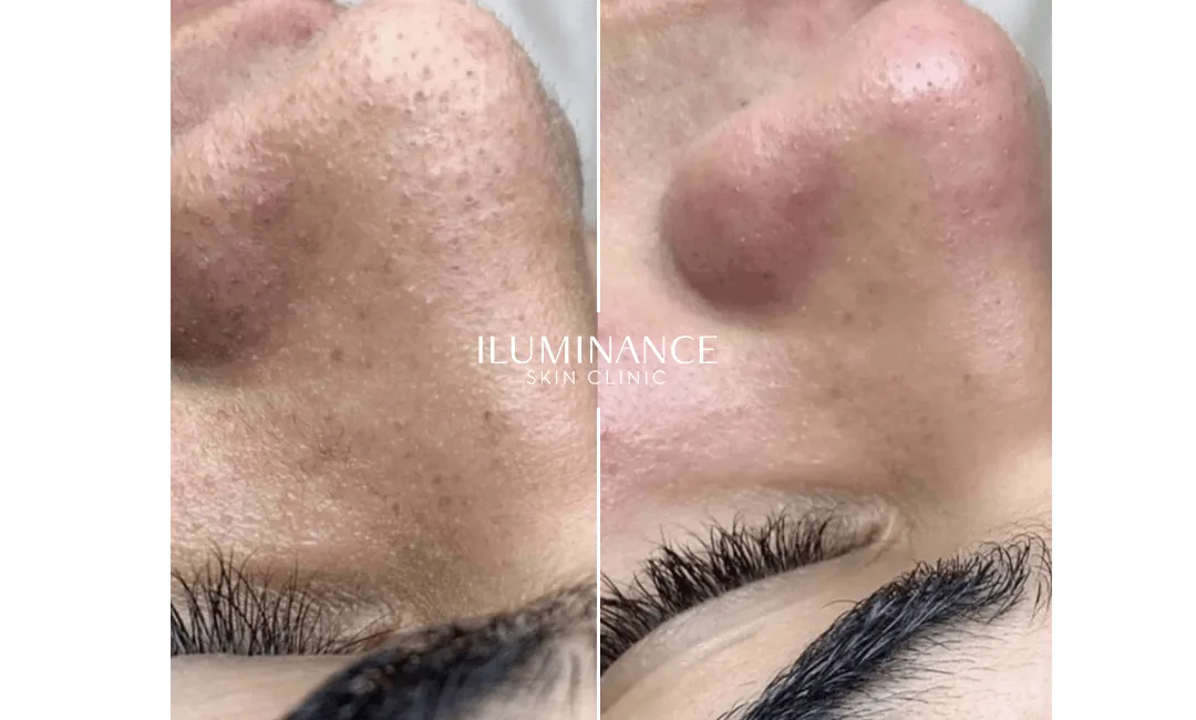 Hydracool - After and Before - results 1 - Iluminance skin clinic