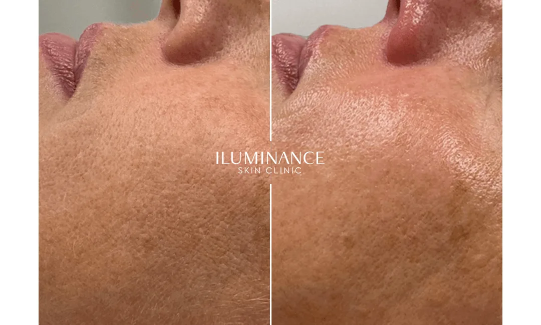 Hydracool - After and Before - results 2 - Iluminance skin clinic
