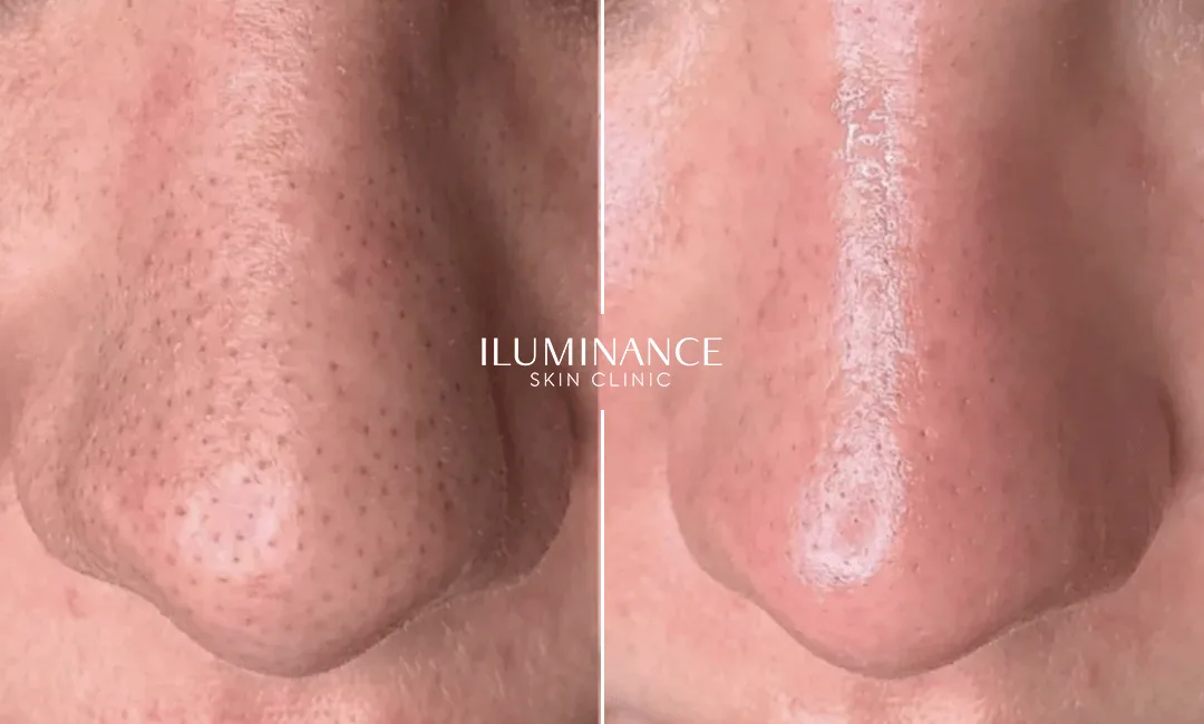 Hydracool - After and Before - results 3 - Iluminance skin clinic
