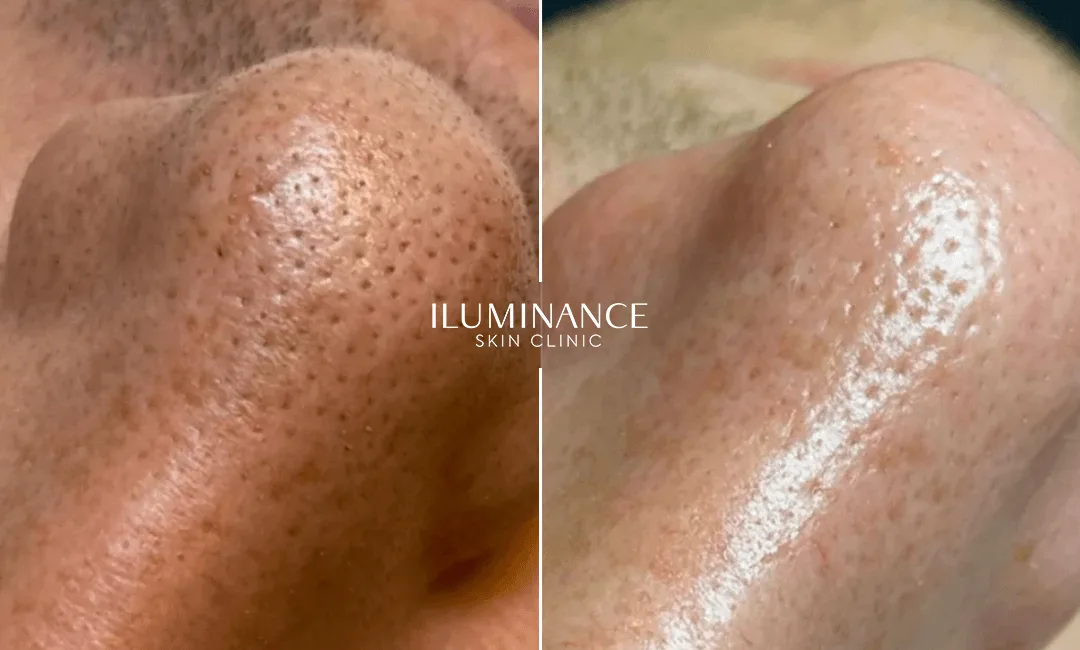 Hydracool - After and Before - results 4 - Iluminance skin clinic