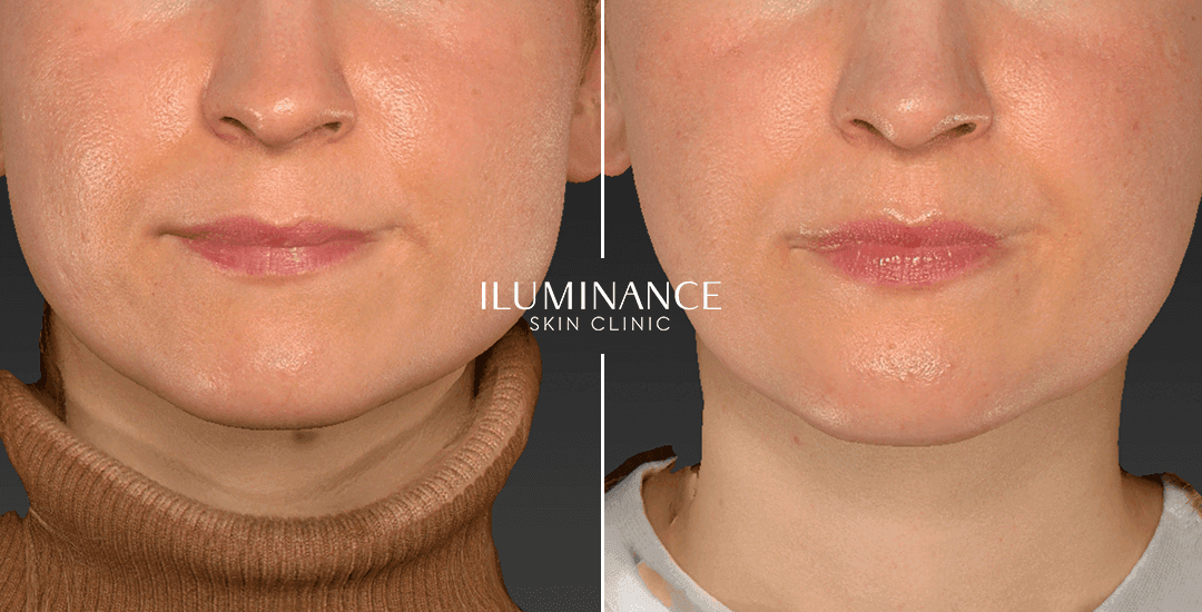 Harmonization - After Before - results 1 - Iluminance skin clinic