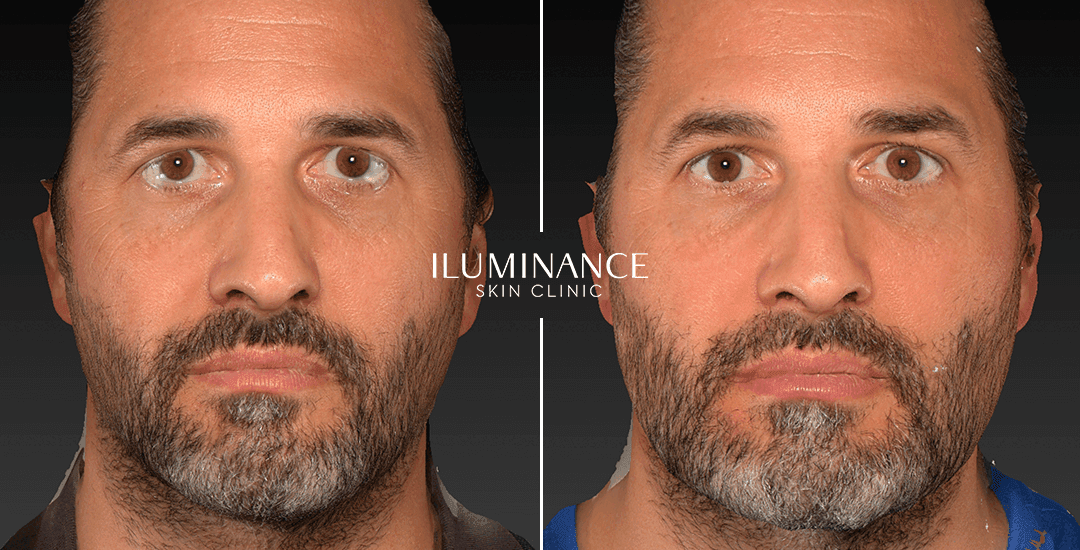 Harmonization - After Before - results 10 - Iluminance skin clinic