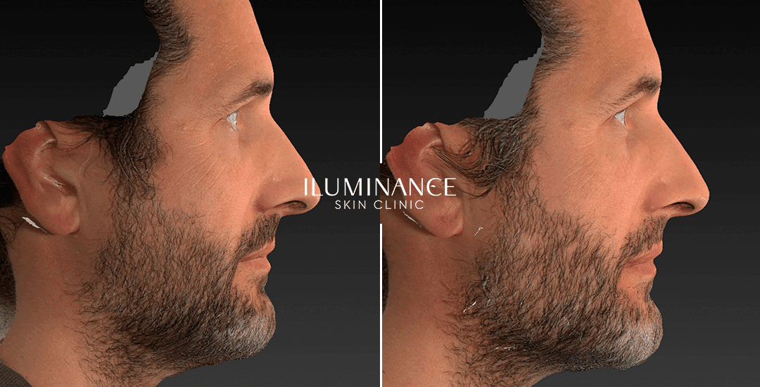 Harmonization - After Before - results 11 - Iluminance skin clinic