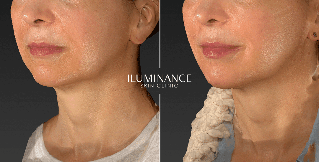 Harmonization - After Before - results 3 - Iluminance skin clinic