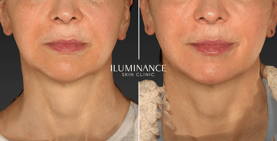 Harmonization - After Before - results 4 - Iluminance skin clinic