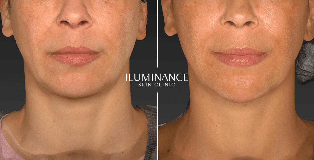 Harmonization - After Before - results 5 - Iluminance skin clinic