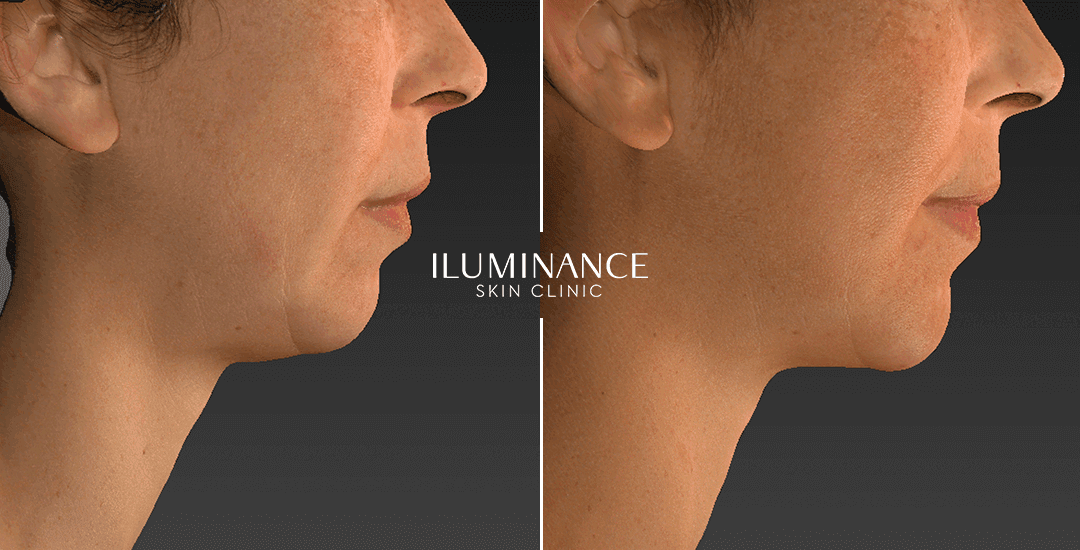 Harmonization - After Before - results 6 - Iluminance skin clinic