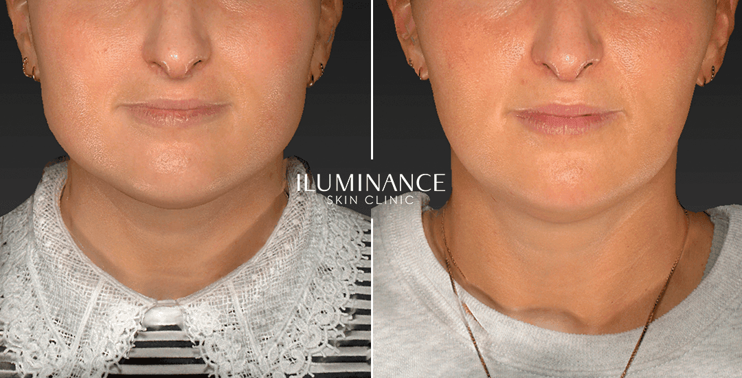 Harmonization - After Before - results 7 - Iluminance skin clinic