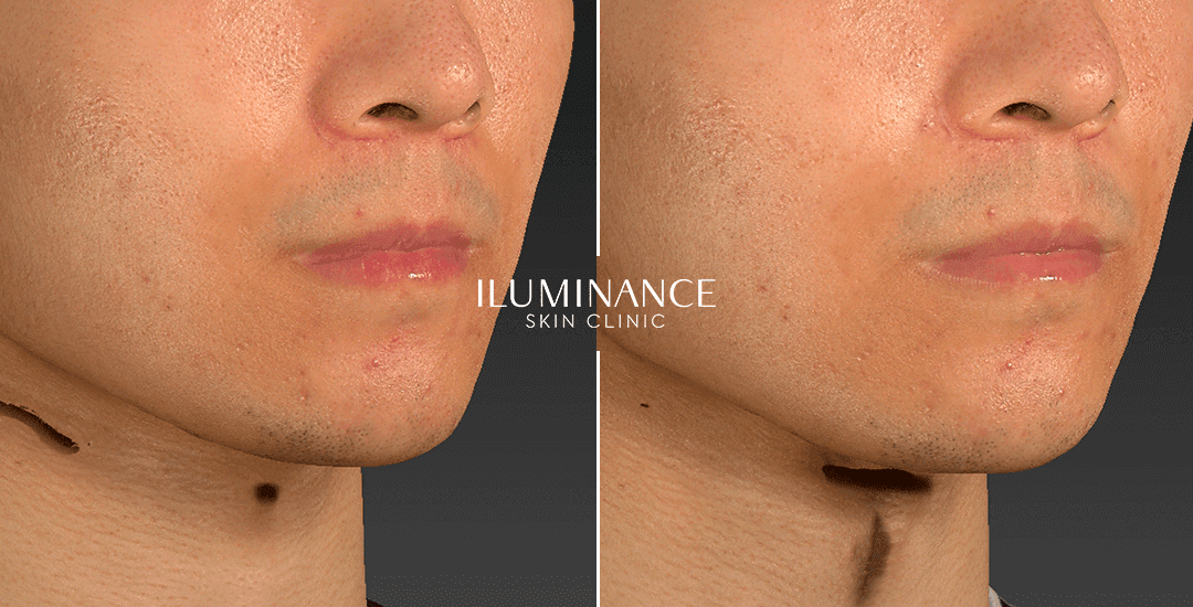 Harmonization - After Before - results 8 - Iluminance skin clinic