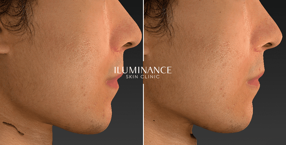 Harmonization - After Before - results 9 - Iluminance skin clinic